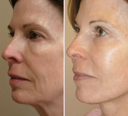 V-Face Lifting Invisible Adhesive Tape