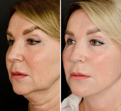 V-Face Lifting Invisible Adhesive Tape